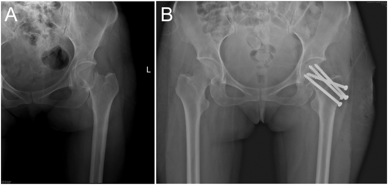 Depot medroxyprogesterone acetate (DMPA)-associated early-onset osteoporotic fracture.