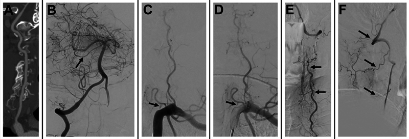 Unmasking vertebral artery stump syndrome in recurrent posterior strokes treated with endovascular therapy.