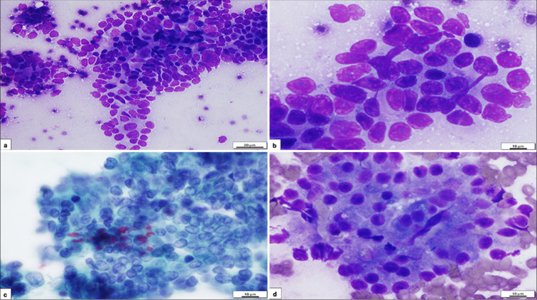 Comprehensive analysis of pancreatic fine needle aspiration cyto-histopathological correlation.