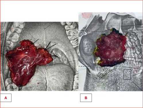 Surgical margins after open versus transoral surgery for oropharyngeal cancer and their impact on the need for multimodal treatments.