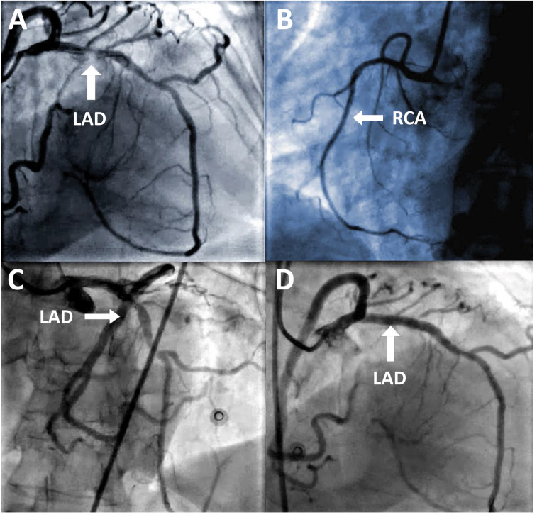 Anomalous Origin of the Posterior Descending Artery Causing Inferolateral Myocardial Ischaemia in an Octogenarian.