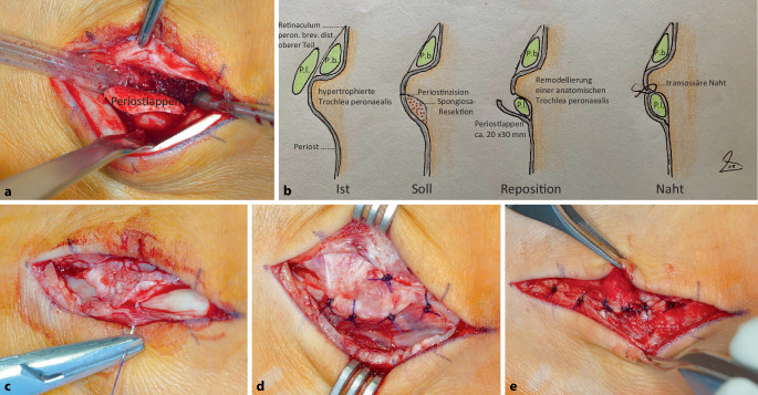 [Pathological rupture of the distal peroneal retinaculum with dislocation of the peroneus longus tendon in a high jump champion : A 15-year case study].