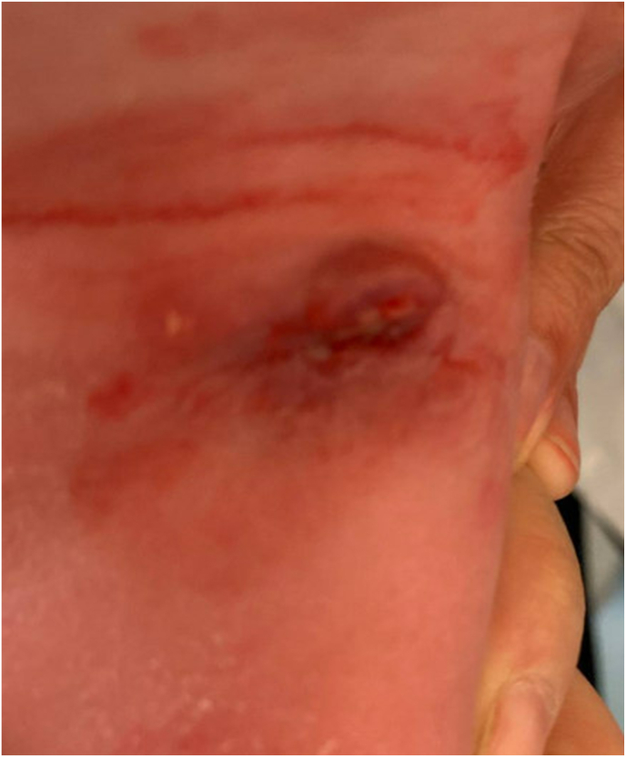 Pearls to Address Challenges in Initial Casting Treatment for Idiopathic Clubfoot.