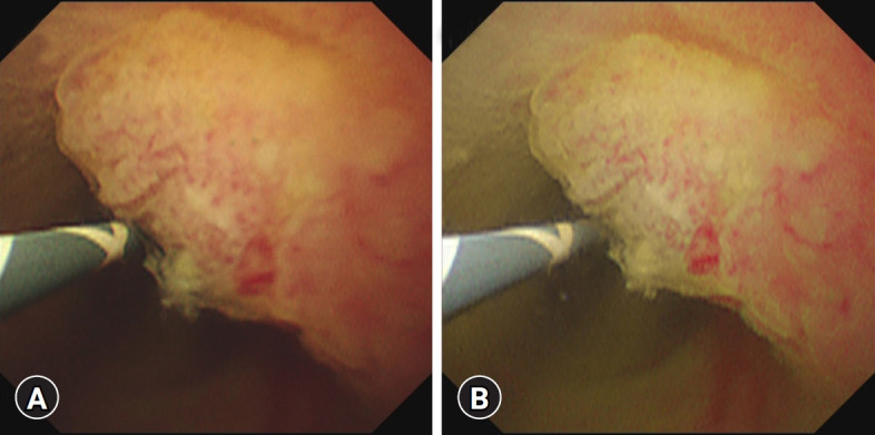Peroral cholangioscopy: past, present and future.