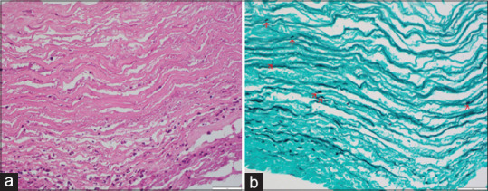 <i>Purpureocillium lilacinum</i> keratitis in a methamphetamine user: Case report.