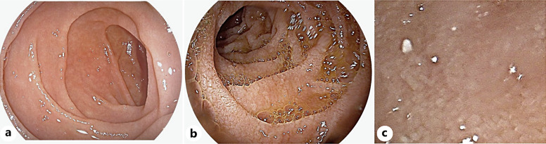 Celiac Disease as a Cause of Malabsorption: A Clinic-Pathological Series of Five Cases.