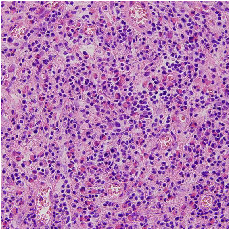 Clinical characteristics and treatment of unilateral allergic fungal rhinosinusitis: a retrospective case series and literature review.