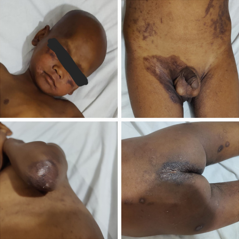 Recurrent Acrodermatitis Enteropathica in a Pediatric Patient: A Rare Case Report with Zinc Deficiency and Complications.