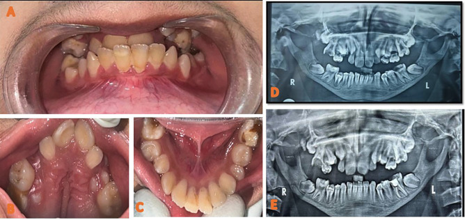 A Rare Case of Pyknodysostosis (Toulouse-Lautrec Syndrome): Dental Perspectives on Comprehensive Management.