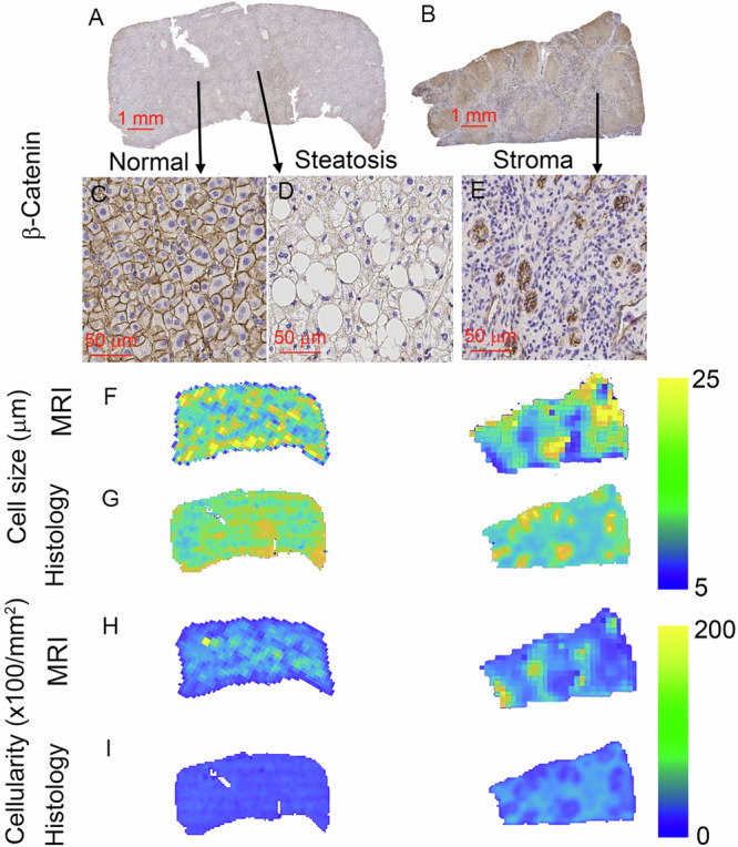 Noninvasive assessment of liver inflammation in metabolic dysfunction associated steatohepatitis using MR cytometry.
