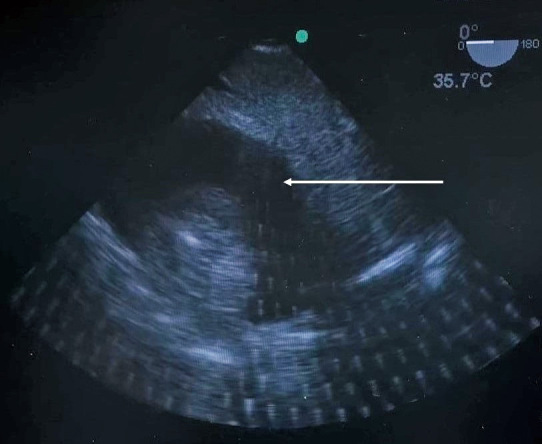 Importance of anesthesiologists' non-technical skills in the management of a case of life-threatening cardiac tamponade during robot-assisted thoracic surgery.