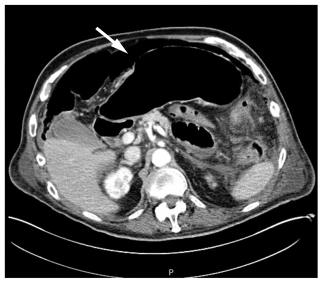 Beyond the Bowel: Lung Cancer Presenting as Complicated Diverticulitis.