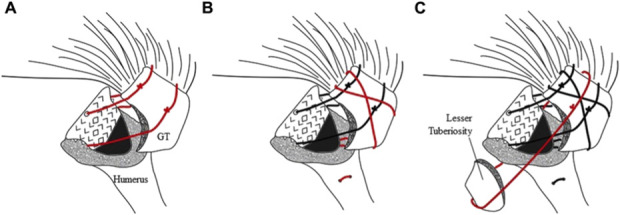 Cow Hitch Cerclage Suture Fixation of the Greater Tuberosity in Reverse Total Shoulder Arthroplasty Performed for Proximal Humerus Fractures: A Retrospective Cohort Study With a Minimum Follow-up of 2 Years.