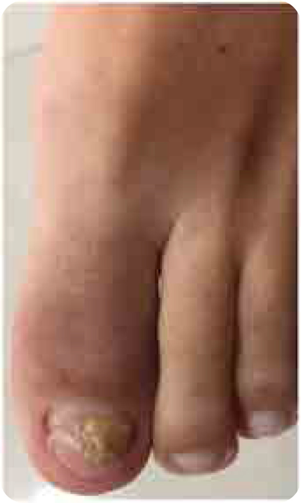 Psoriatic Onycho-Pachydermo Periostitis (POPP).