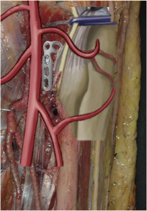 Current concepts in tibial plateau fracture management: a Spanish Orthopaedic Trauma Association review.