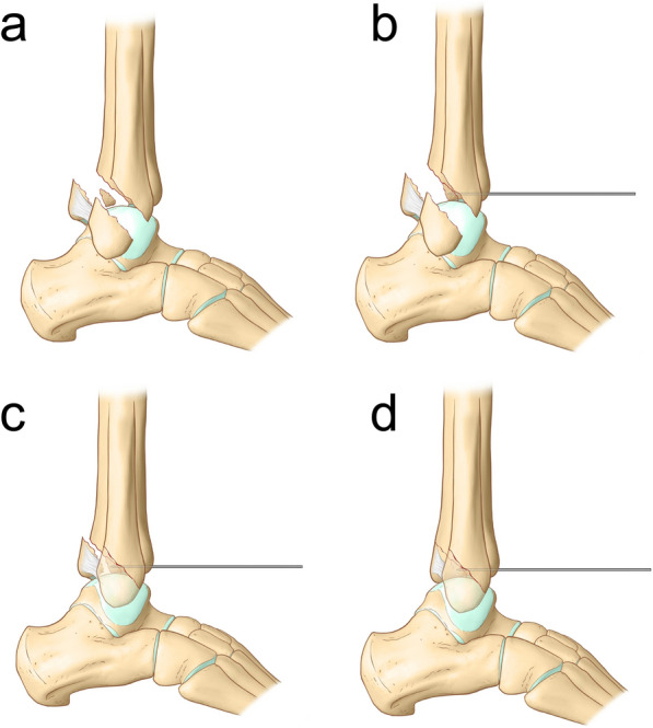 Reduction and outcome of posterior pilon fractures with intercalary fragments: a retrospective cohort study comparing the transfibular and posteromedial approaches.