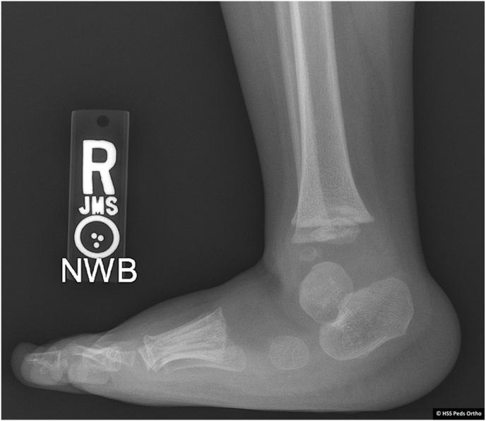 Pearls to Address Challenges in Initial Casting Treatment for Idiopathic Clubfoot.