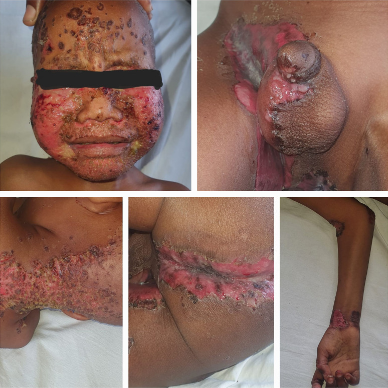 Recurrent Acrodermatitis Enteropathica in a Pediatric Patient: A Rare Case Report with Zinc Deficiency and Complications.