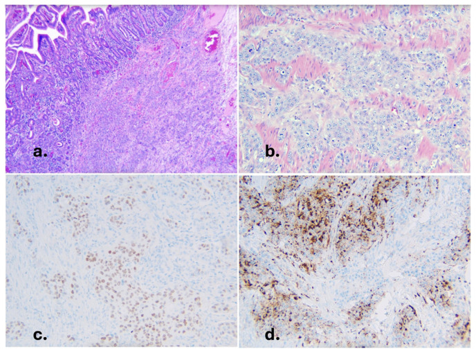 Beyond the Bowel: Lung Cancer Presenting as Complicated Diverticulitis.