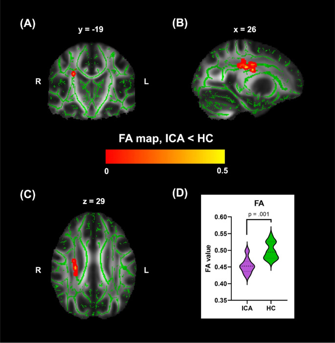 Altered white matter architecture in patients with isolated congenital anosmia.