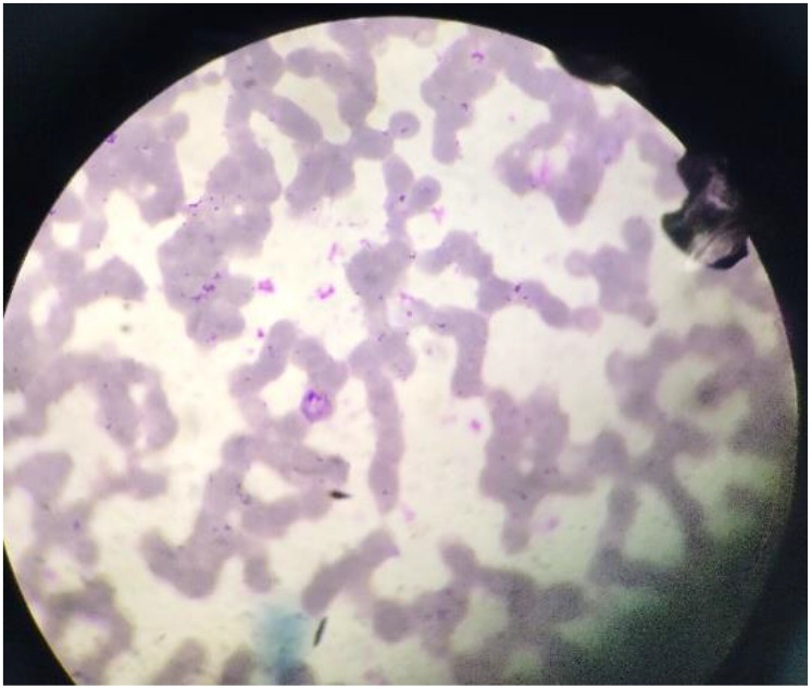 Symmetrical Peripheral Gangrene Associated with <i>Plasmodium Vivax</i> Malaria: <i>A case report with a brief review of literature</i>.