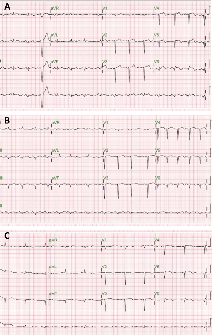 Anomalous Origin of the Posterior Descending Artery Causing Inferolateral Myocardial Ischaemia in an Octogenarian.