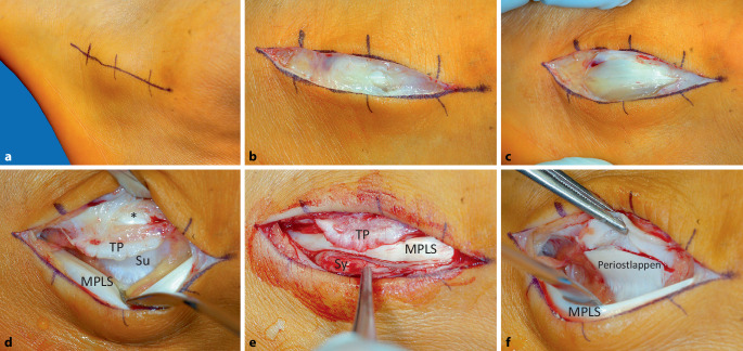 [Pathological rupture of the distal peroneal retinaculum with dislocation of the peroneus longus tendon in a high jump champion : A 15-year case study].