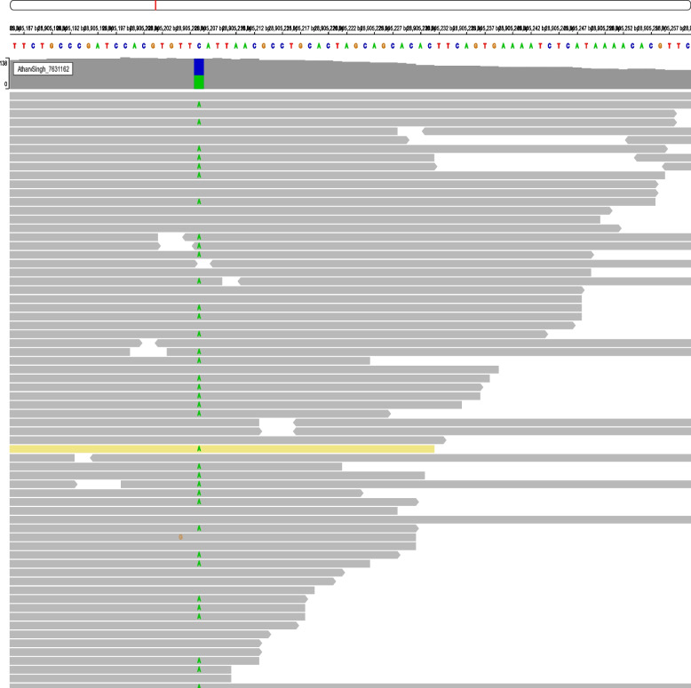 Novel WAC gene variant identified in the first documented case of DeSanto-Shinawi Syndrome in India.