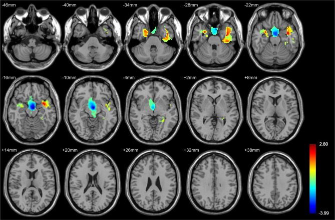 Morphometric and radiomics analysis toward the prediction of epilepsy associated with supratentorial low-grade glioma in children.