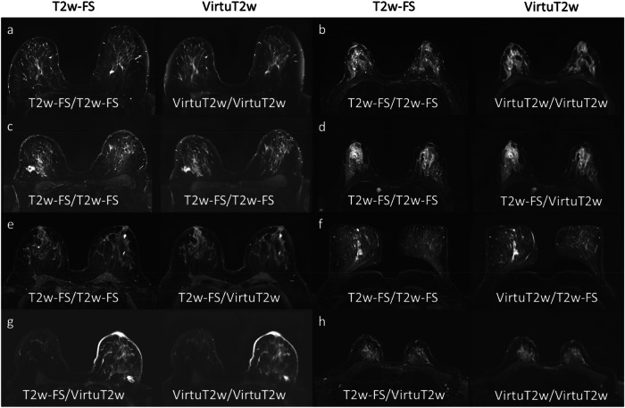 Feasibility of virtual T2-weighted fat-saturated breast MRI images by convolutional neural networks.