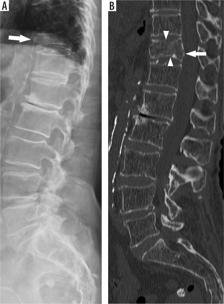 Diagnostic accuracy of plain films in detection of thoracolumbar fractures in minor trauma patients: comparison with CT.