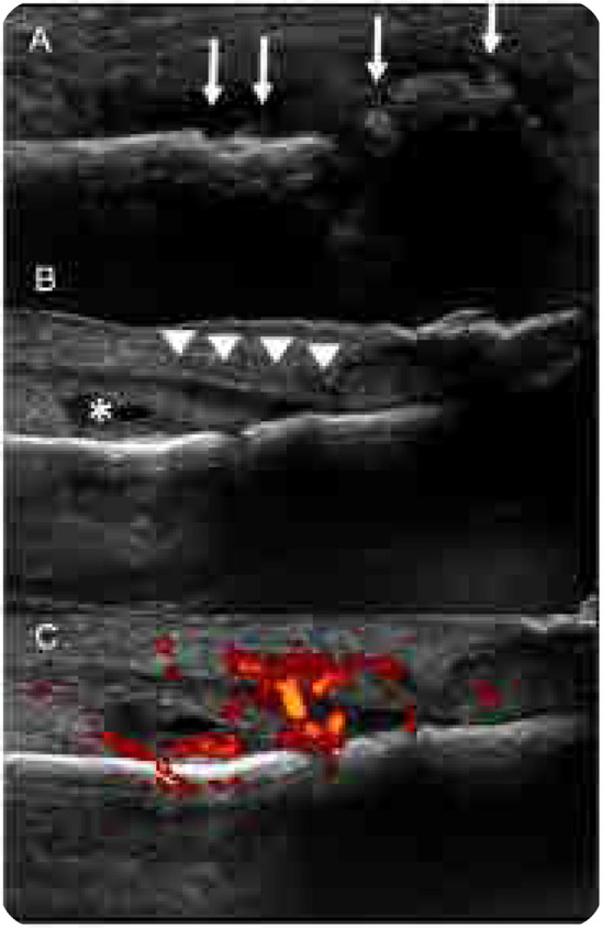 Psoriatic Onycho-Pachydermo Periostitis (POPP).
