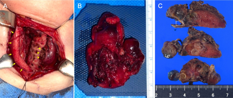 Unusual nodular goiter with recurrent laryngeal nerve palsy due to severe degeneration caused by intense chronic inflammation: a case report with histopathological evidence and review of the literature.