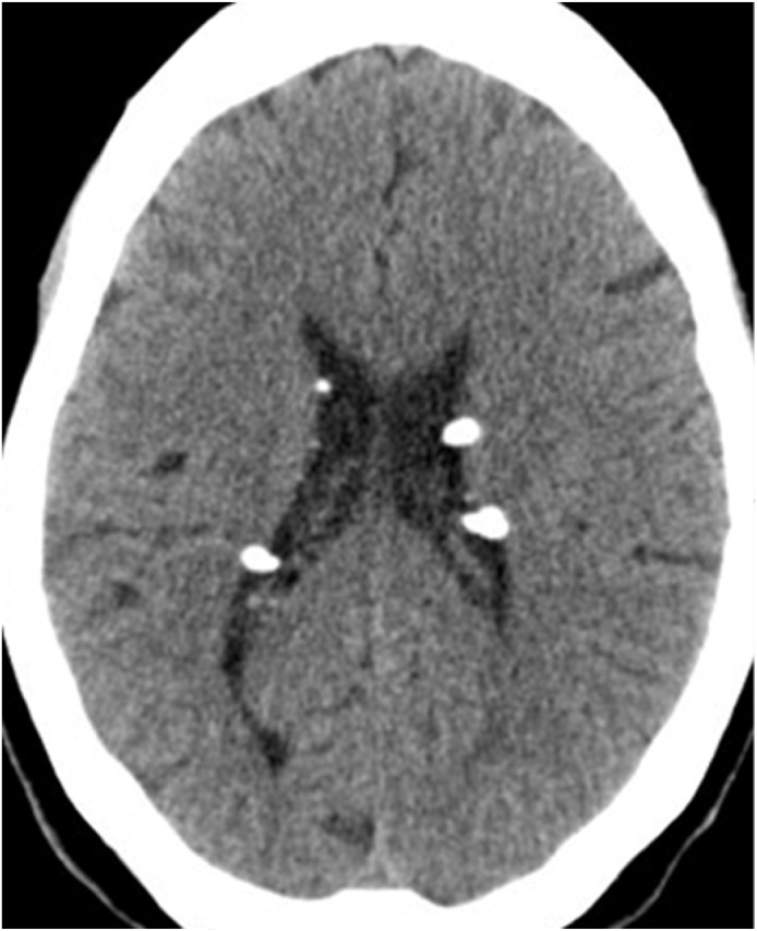 The Multifaceted Nature of Tuberous Sclerosis Complex.