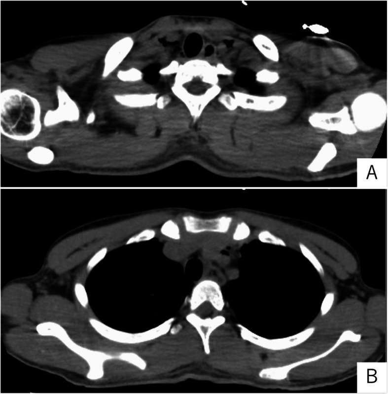 Hamman's syndrome in a patient with uncontrolled type 1 diabetes mellitus: a case report.