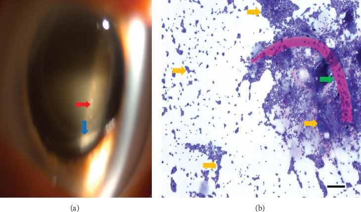 <i>Staphylococcus cohnii</i> Causing a Latent Endophthalmitis: A Case Report.