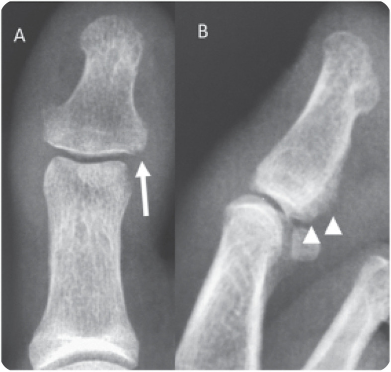 Psoriatic Onycho-Pachydermo Periostitis (POPP).