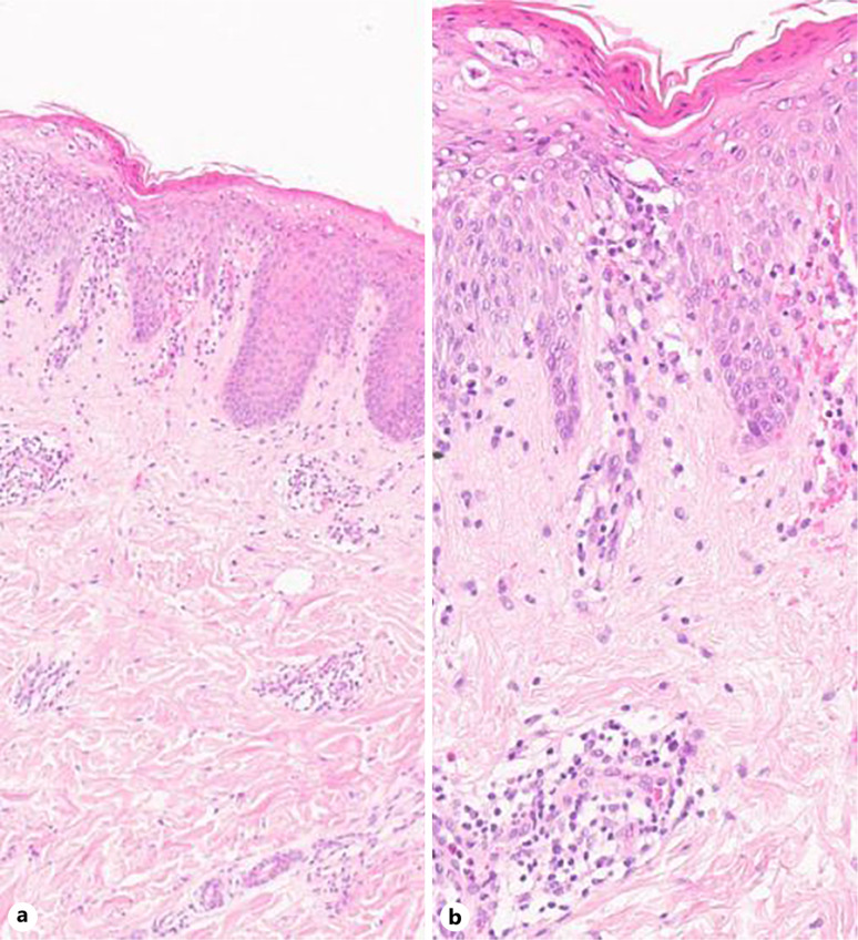 Dupilumab's Successful Journey in Pityriasis Lichenoides Chronica Followed by the Intriguing Reemergence of Vitiligo after Monobenzone Depigmentation: A Case Report.