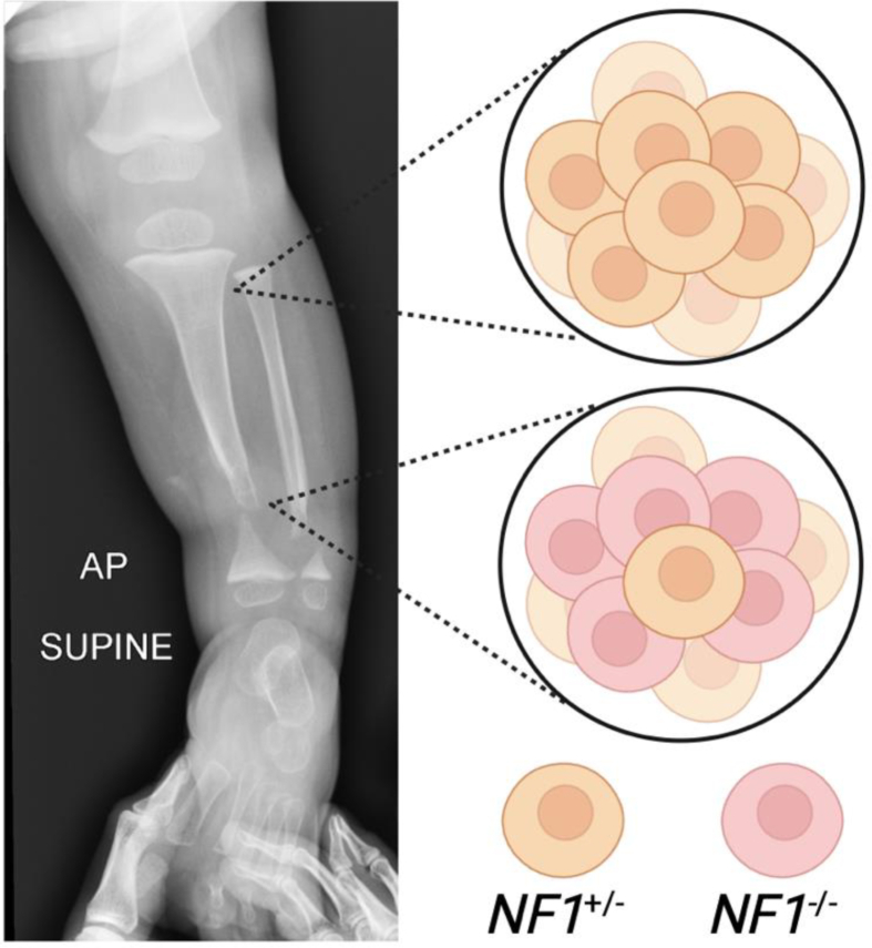 Molecular Basis of Fracture Pseudarthrosis Associated with Neurofibromatosis Type 1.