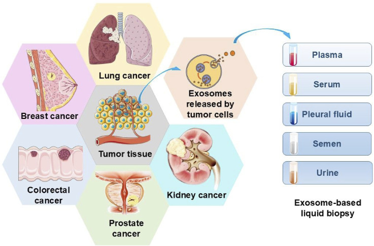 Exosome-Based Liquid Biopsy in Early Screening and Diagnosis of Cancers.