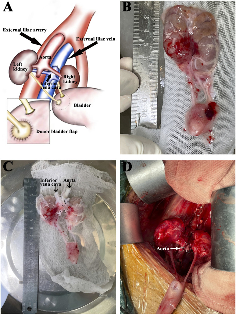 <i>En-Bloc</i> Kidney Transplantation From Extremely Low-Weight (0.9-5.0 kg) Pediatric Donors: A Decade of Single-Center Experience.