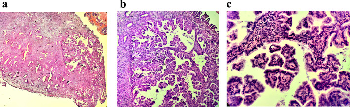 Complex papillary hyperplasia of the endometrium: an uncommon case report with cytopathological features and diagnostic implications.