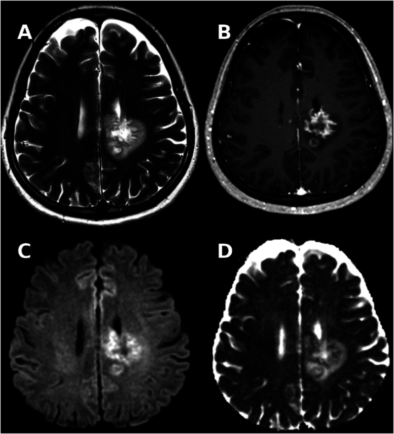 Paraneoplastic Tumefactive Demyelination With Underlying Anaplastic Thyroid Cancer: A Case Report and Review of the Literature.