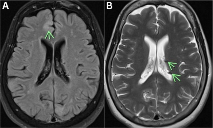 The Multifaceted Nature of Tuberous Sclerosis Complex.