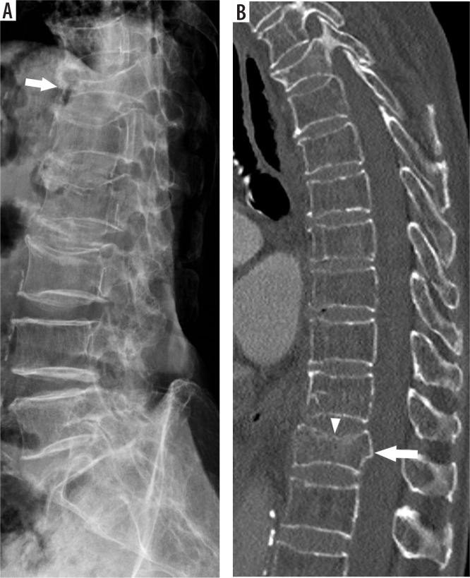 Diagnostic accuracy of plain films in detection of thoracolumbar fractures in minor trauma patients: comparison with CT.