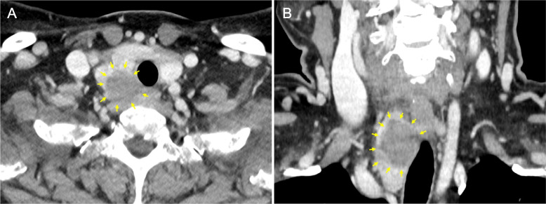 Unusual nodular goiter with recurrent laryngeal nerve palsy due to severe degeneration caused by intense chronic inflammation: a case report with histopathological evidence and review of the literature.