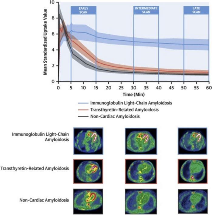 Positron emission tomography in cardiac amyloidosis: current evidence and future directions.