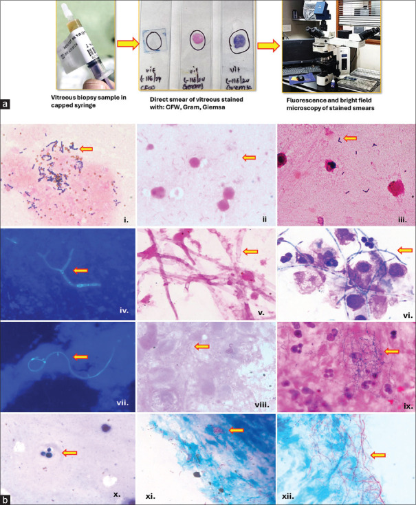 Diagnostic microbiology for intraocular infections: A comprehensive approach.