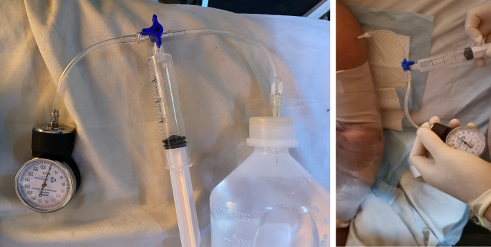 Under pressure: a case of compartment syndrome secondary to crushing injury utilizing Whitesides's apparatus.