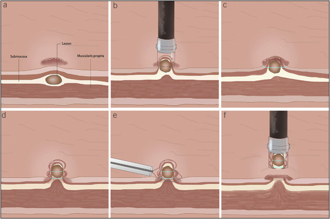 Double Band Ligation-Assisted Endoscopic Submucosal Resection for Rectal Neuroendocrine Tumors: Comparison With Conventional Endoscopic Mucosal Resection With Ligation (With Video).